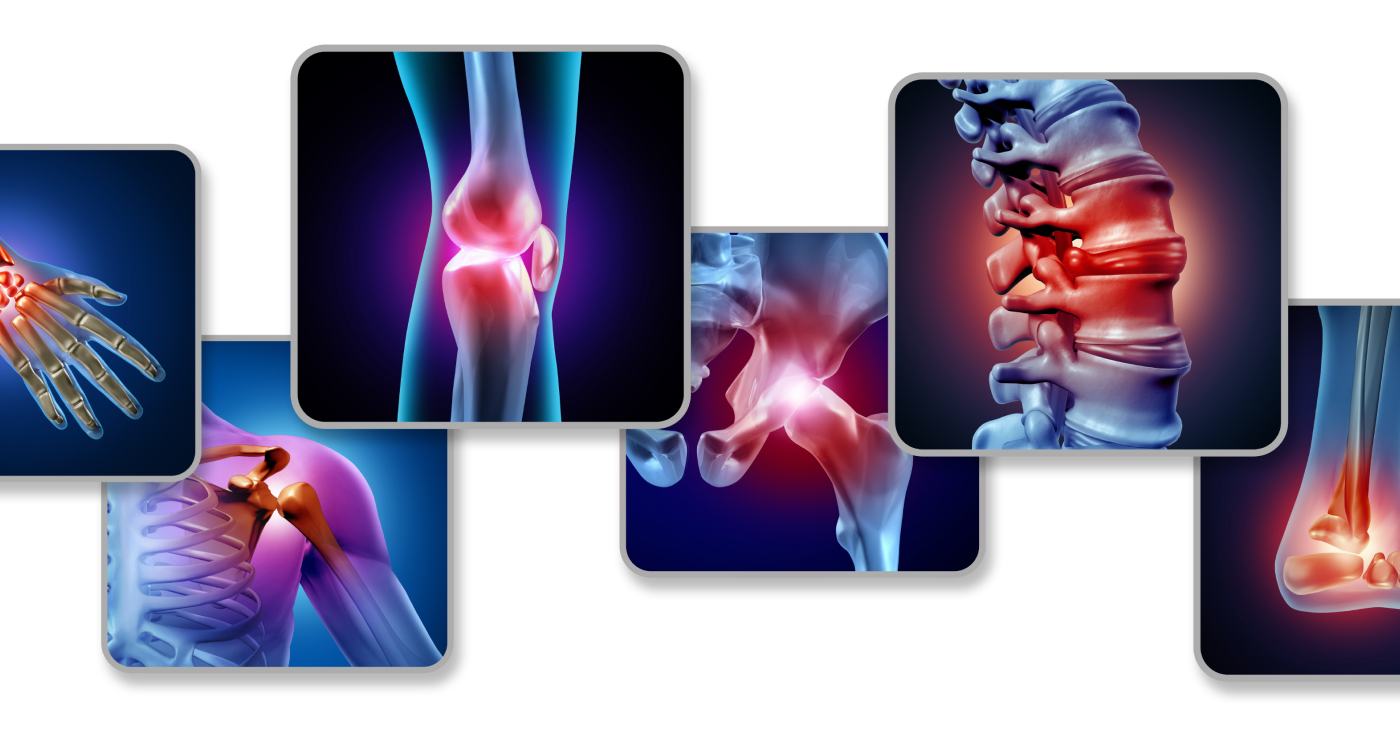 Arthritis: What it is, Symptoms, Causes, and More